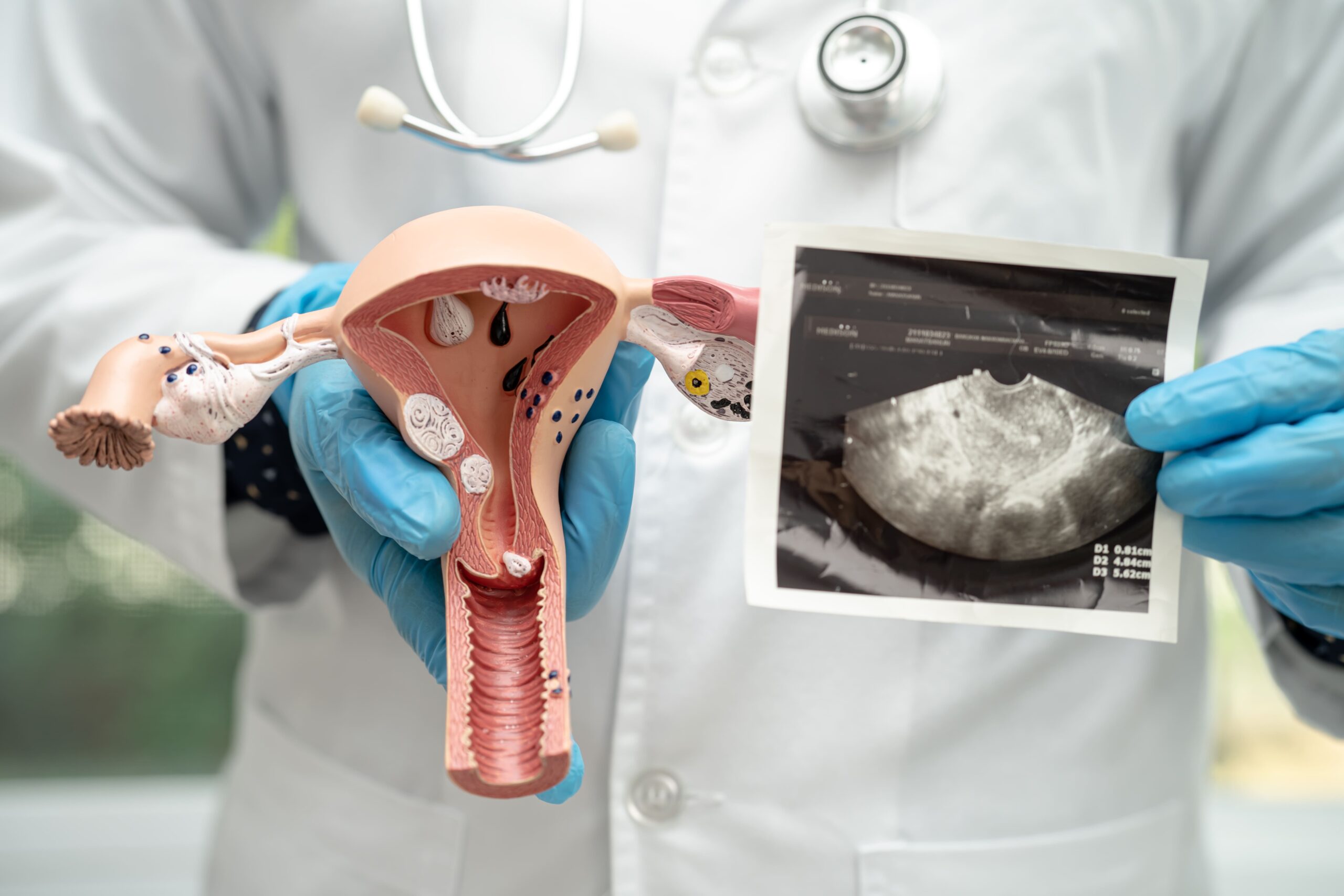 PCOS Treatment in Singapore