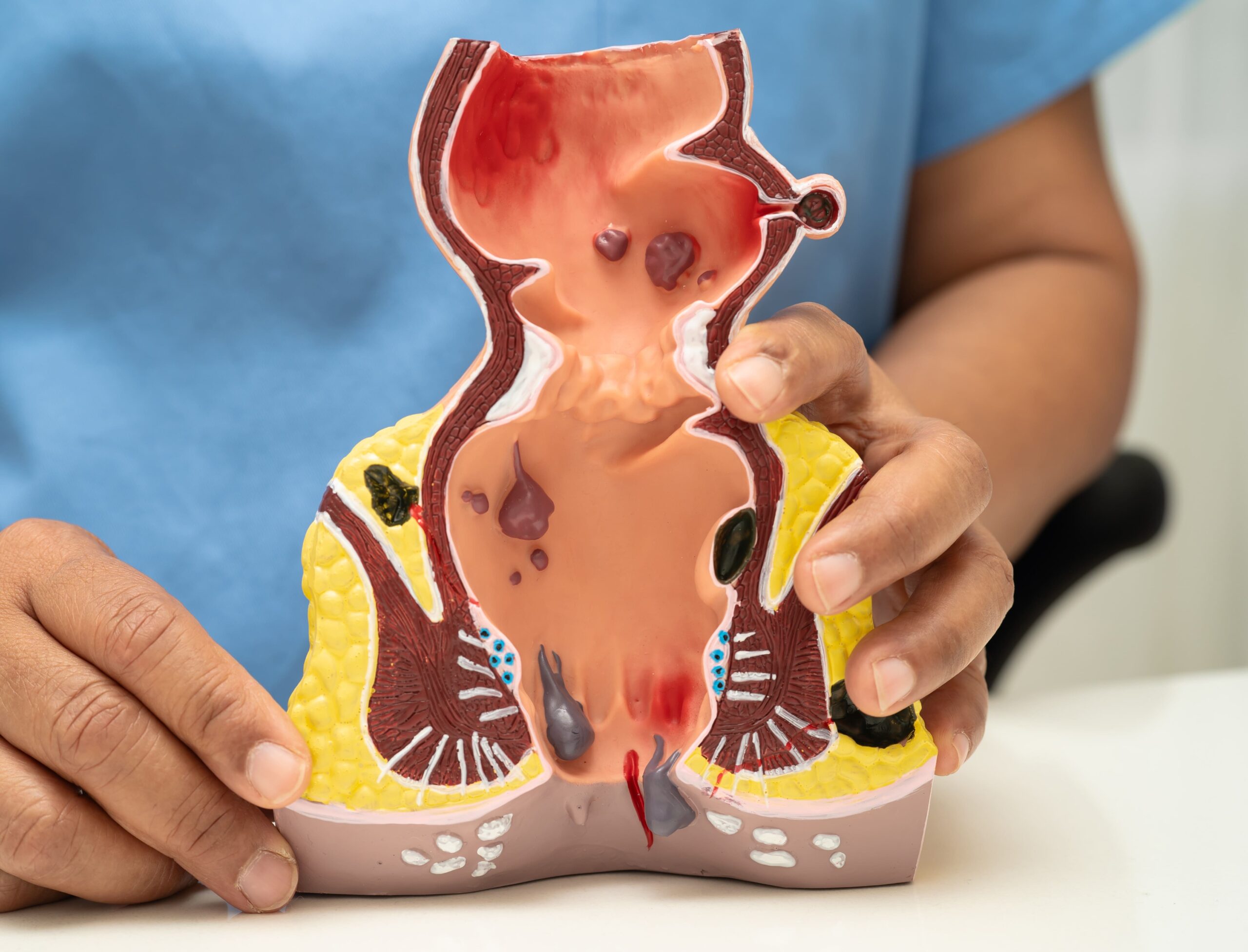 Anal Fistula Surgery in Singapore