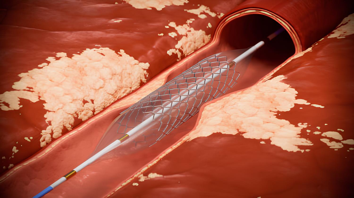 Angioplasty Procedure in Singapore