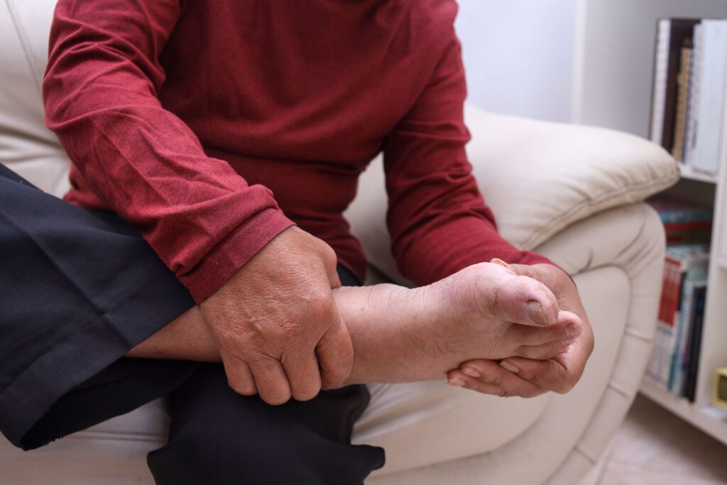 Gout Treatment in Singapore
