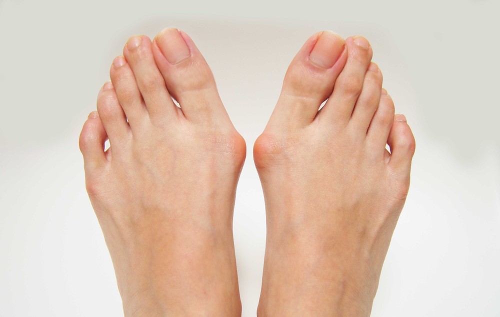 Bunion Surgery in Singapore