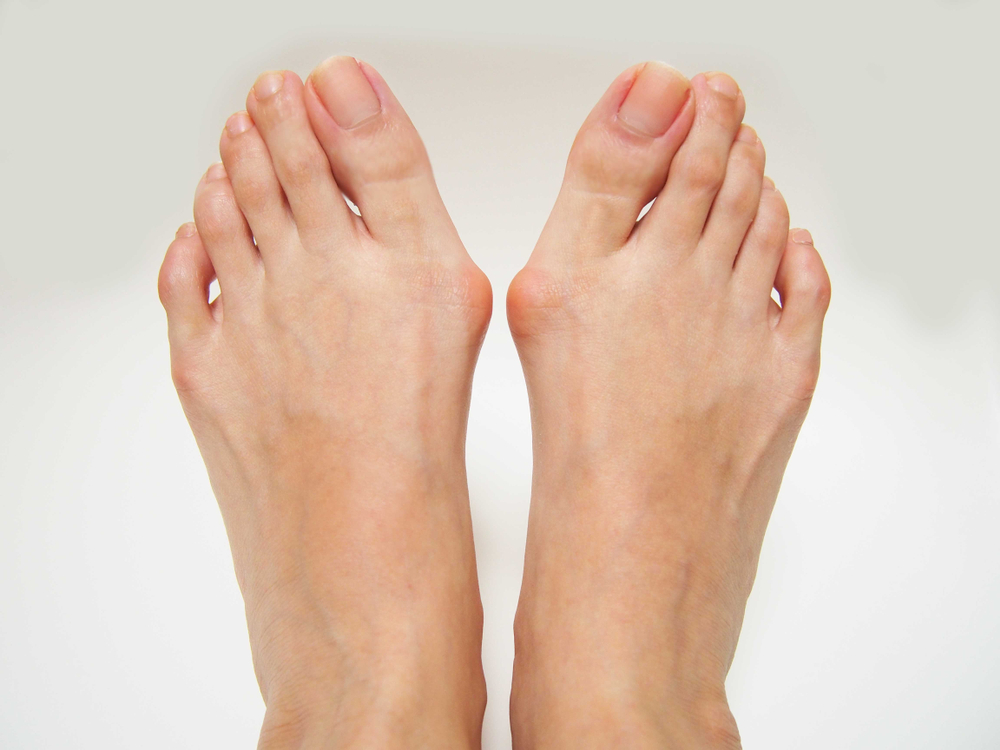 Image Varus,Valgus,And,Hallux,Valgus,,Bunion,On,White,Background.