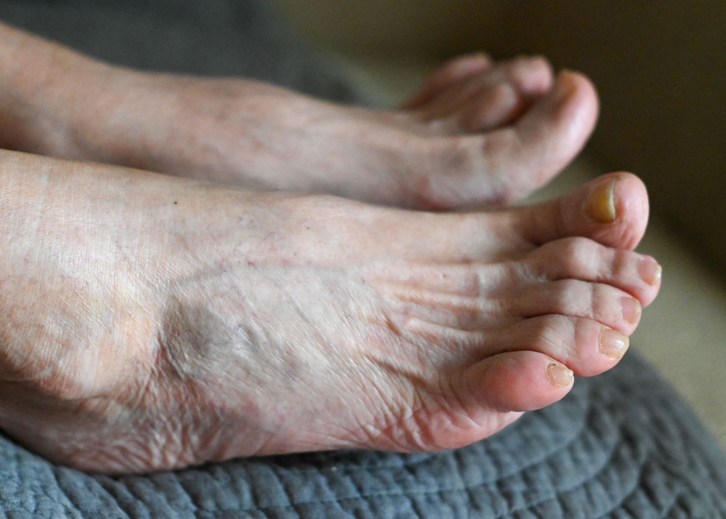 Hammer Toe Surgery in Singapore