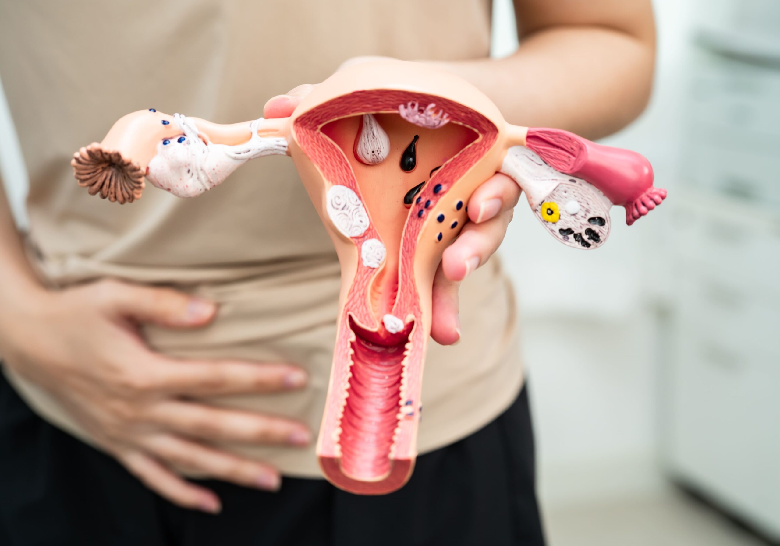 Adenomyosis Treatment in Singapore
