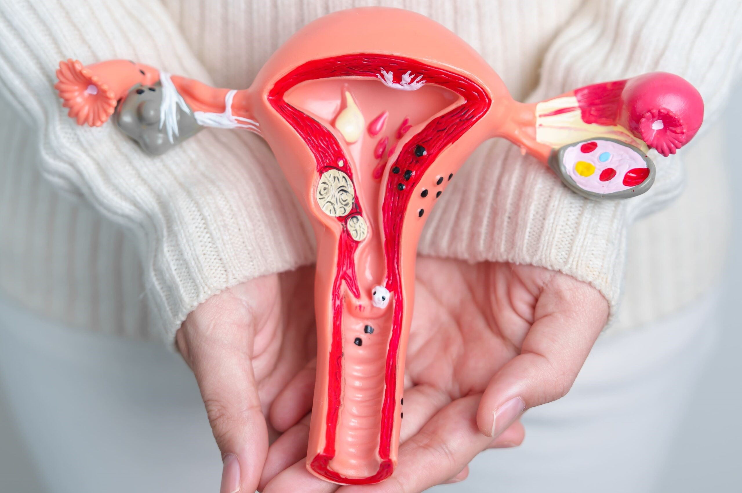 Ovarian Cysts in Singapore