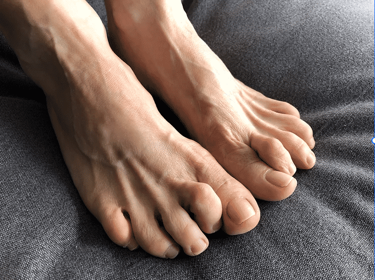 Hammer Toe Singapore