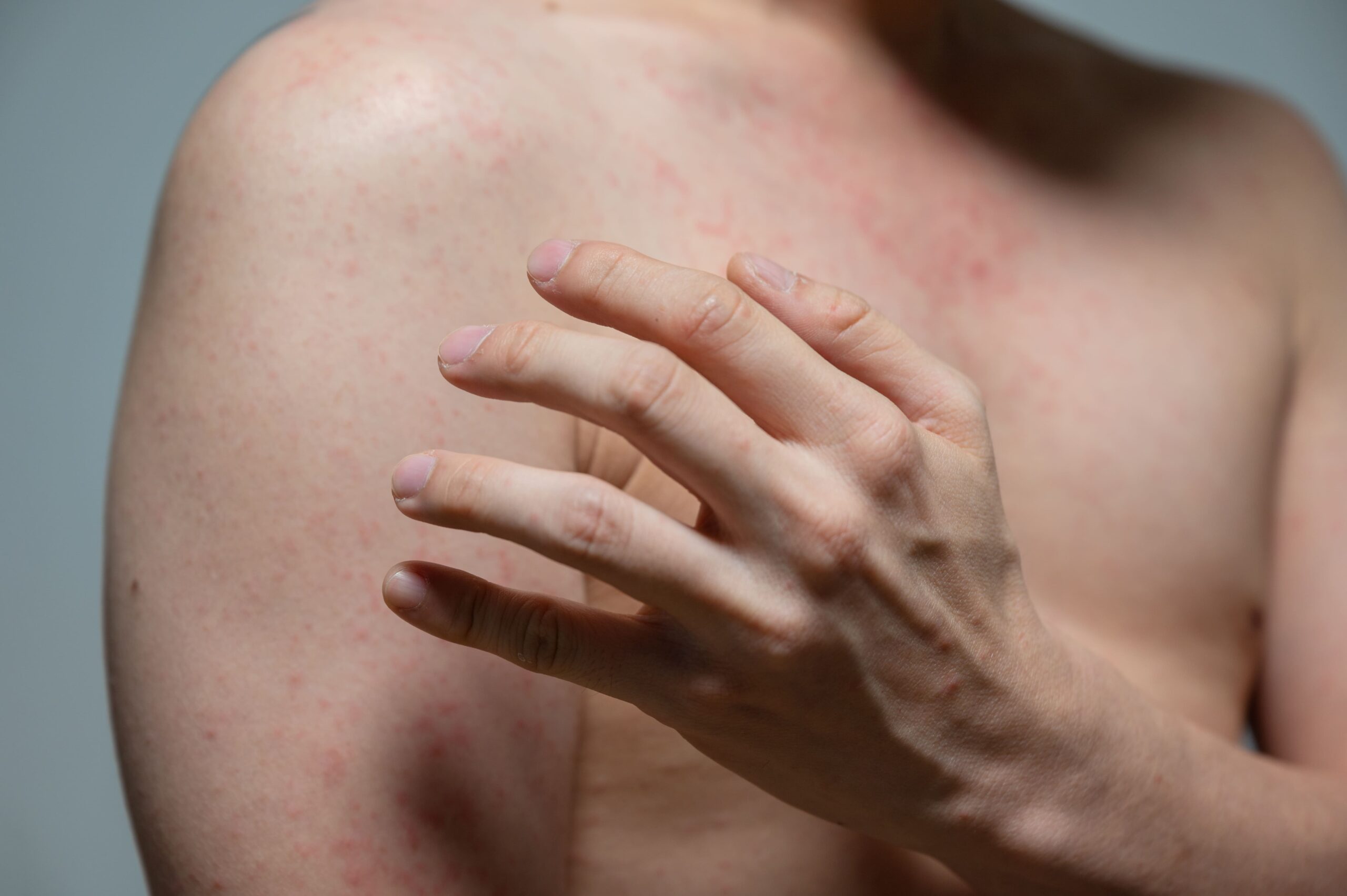 Skin Rash Treatment in Singapore